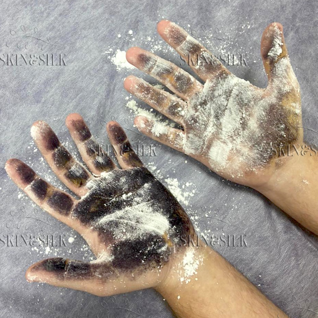 лечение гипергидроза рук у мужчин.jpg