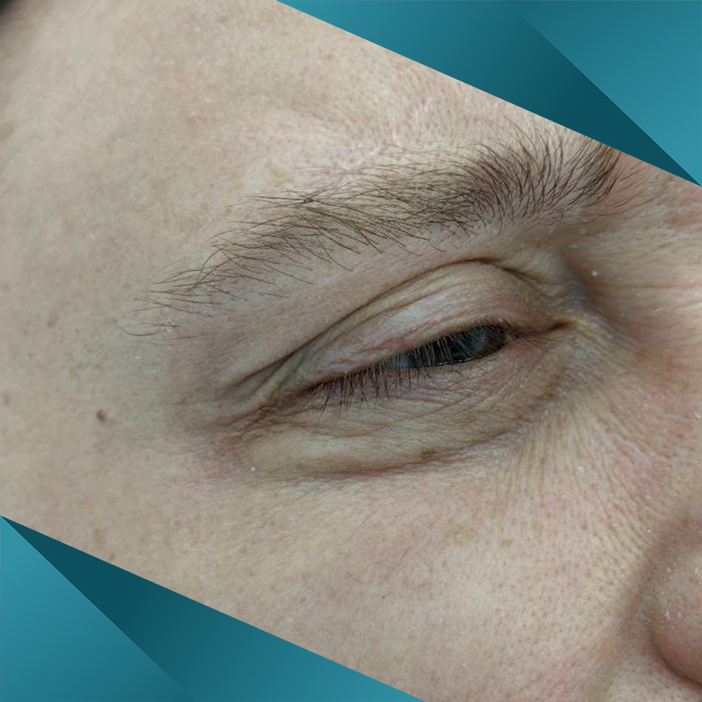 коррекция морщин глаз у мужчин