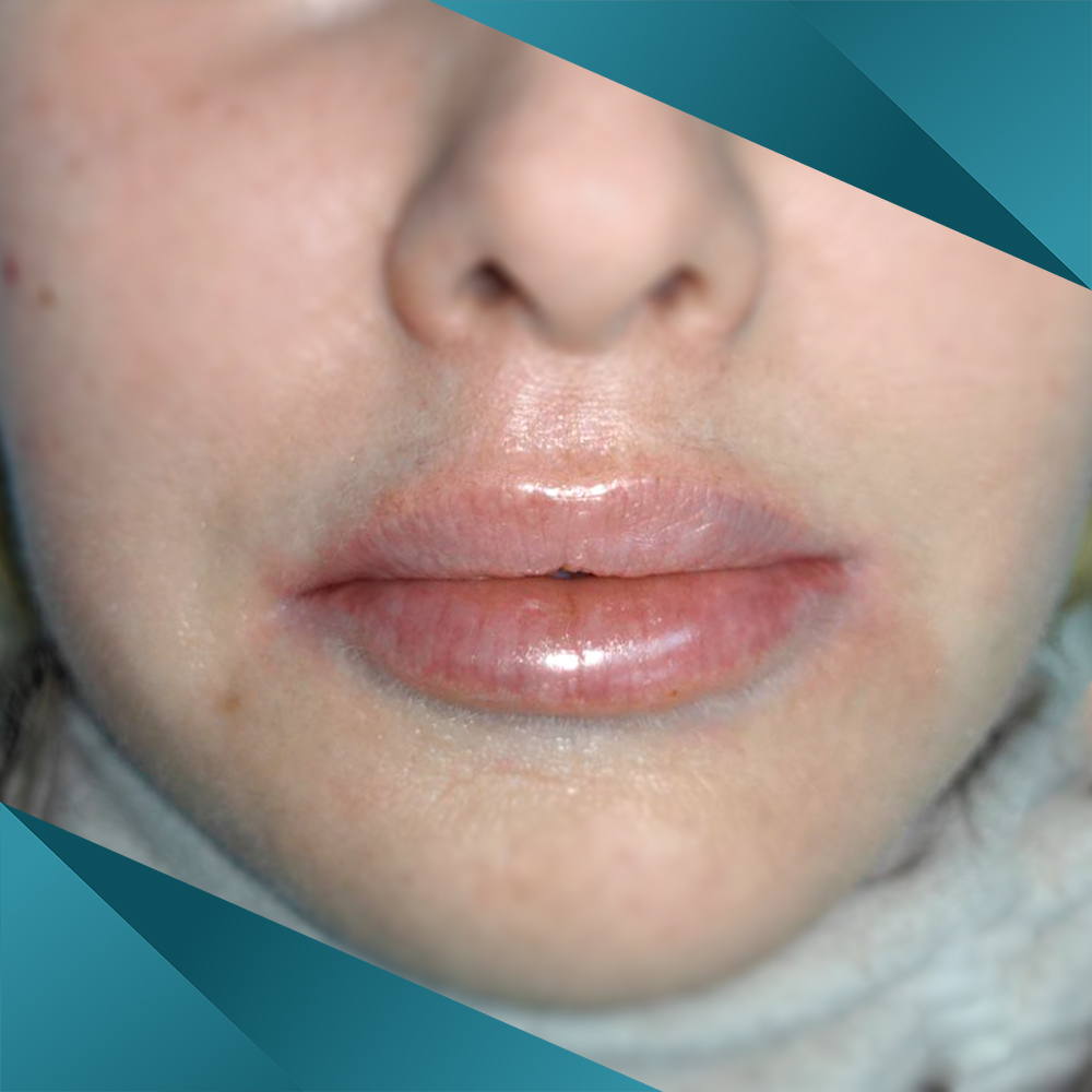 гиалуроновая кислота в губах